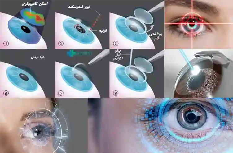 بهترین متخصص لیزیک برای عمل لیزیک چشم