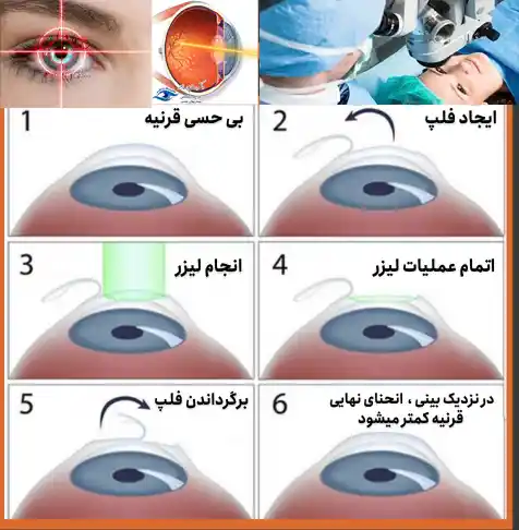انجام عمل لیزیک چشم